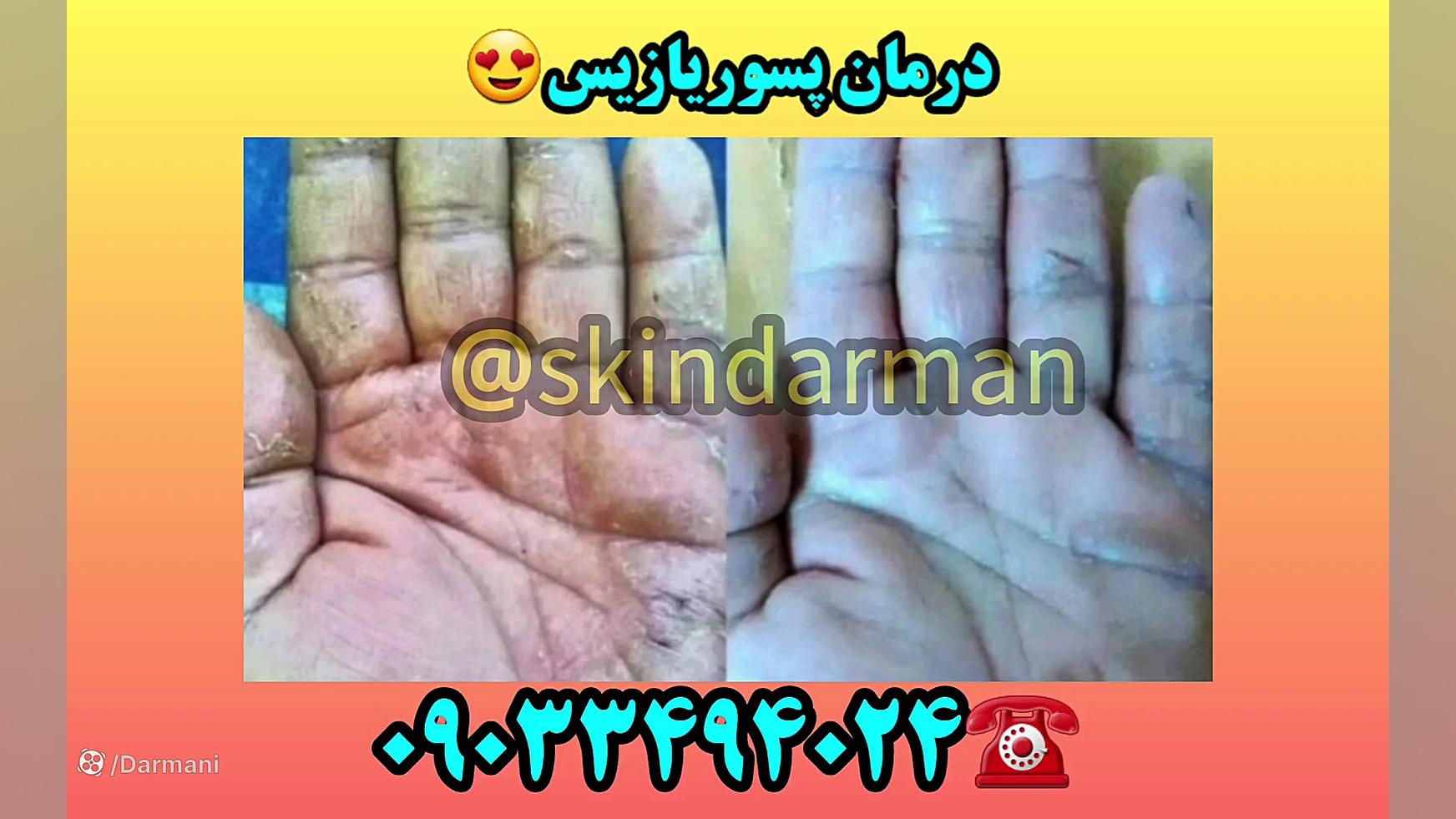 درمان پسوریازیس تزریق چربی