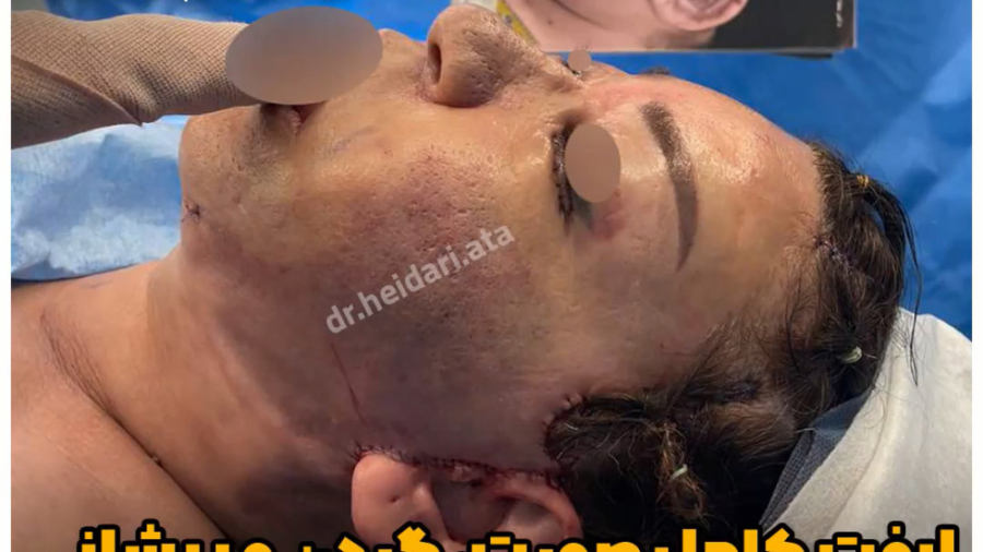 لیفت کامل صورت ، گردن و پیشانی و بلفاروپلاستی پلک پایین ترمیم دندان