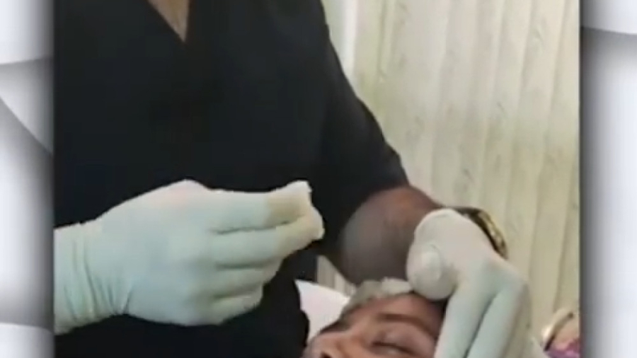 فیلم لیفت کردن صورت با نخ ارتودنسی
