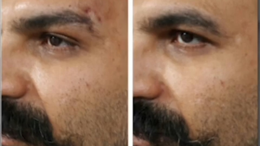 لیفت ابرو با نخ-کلینیک سپاهان بلیچینگ