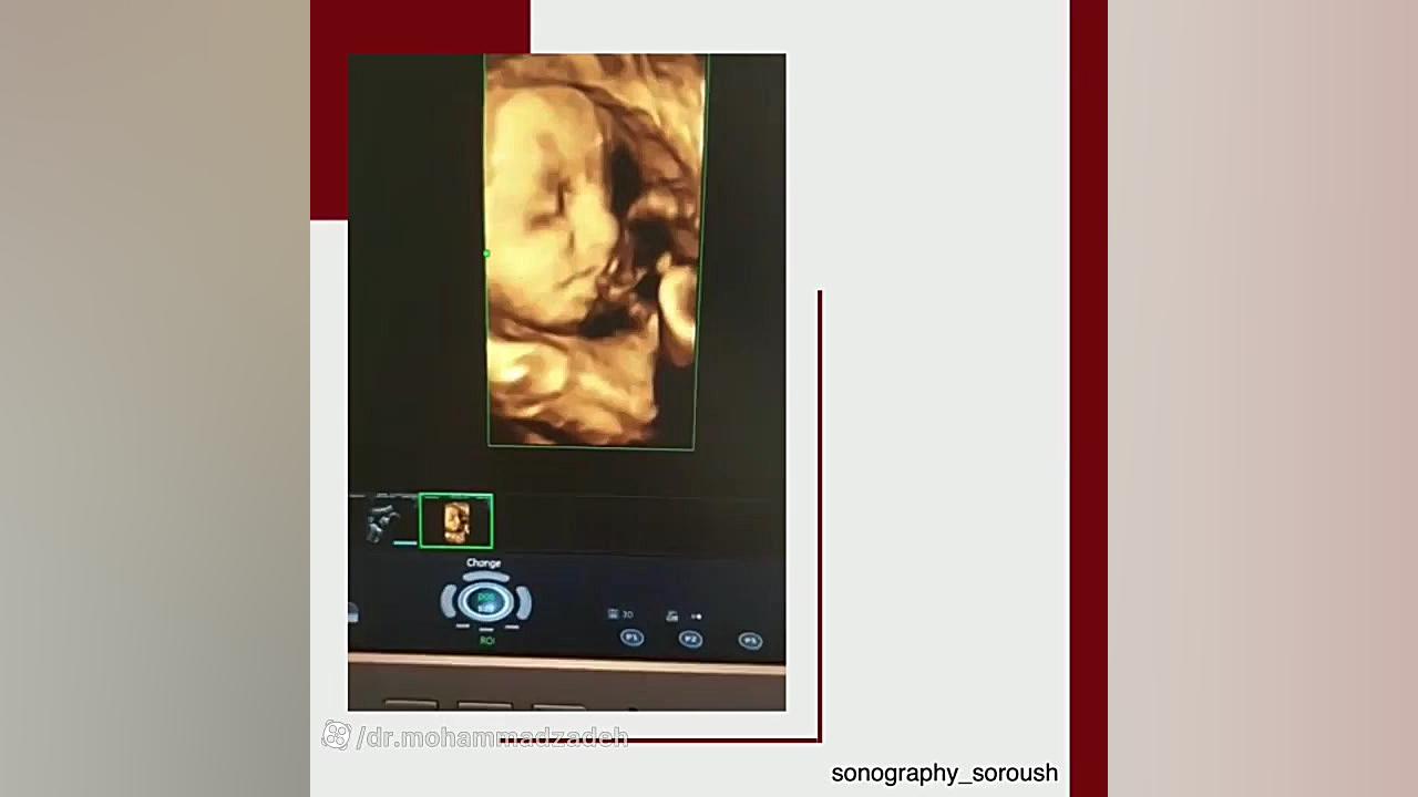 سونوگرافی صورت جنین ۳۳ هفته فیلم خفن