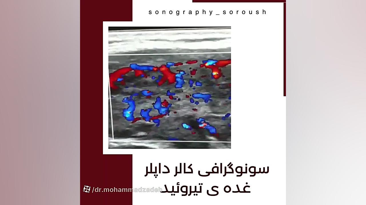 سونوگرافی کالر داپلر غده ی تیروئید بلیچینگ