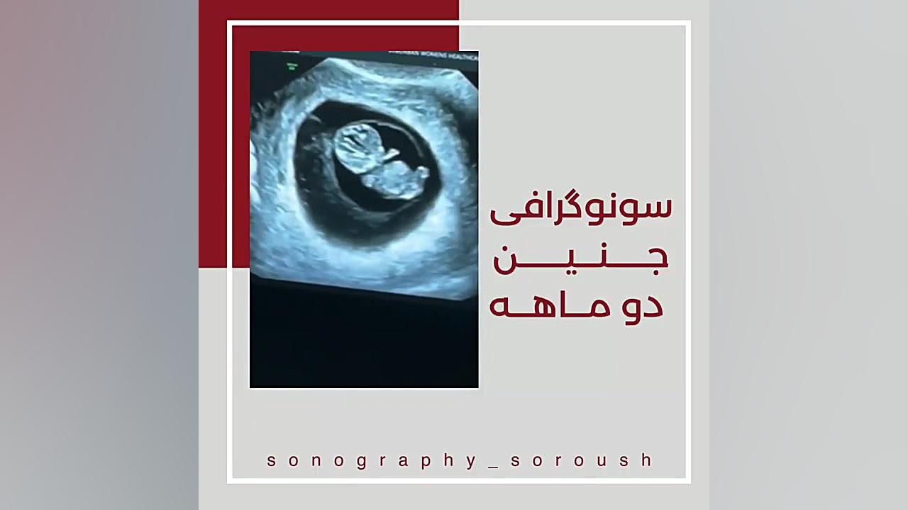 سونوگرافی جنین دو ماهه کله پوک