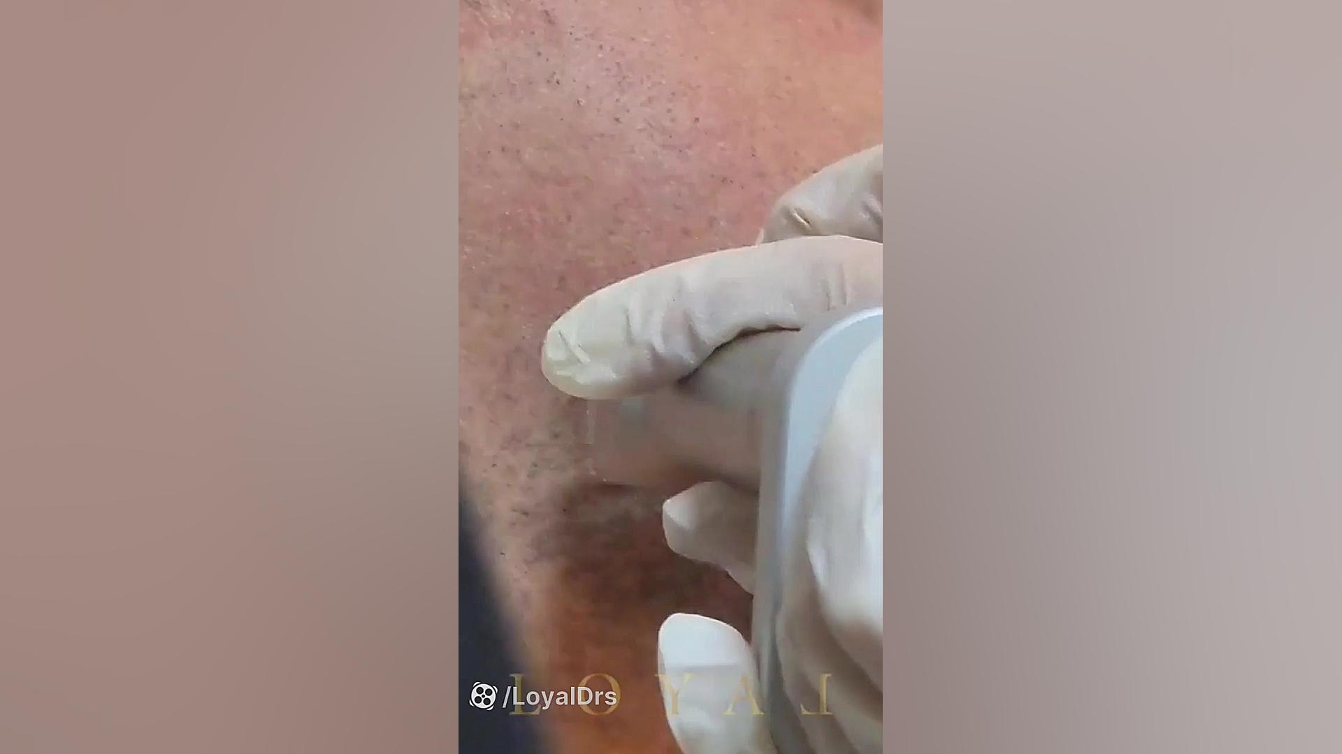 لیزر صورت مردان برای جای جوش _ پزشکان لویال _ فیلم لیزر فرکشنال CO2 بلیچینگ دندان