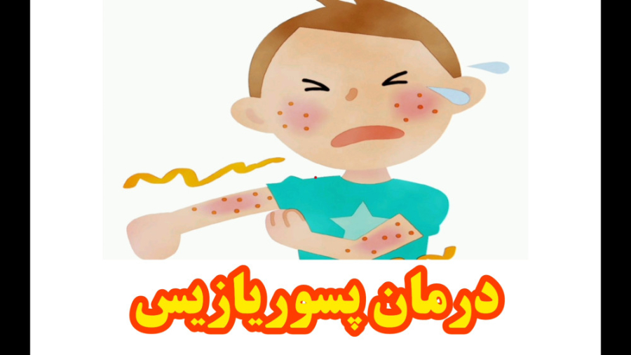 درمان پسوریازیس شادمهر عقیلی
