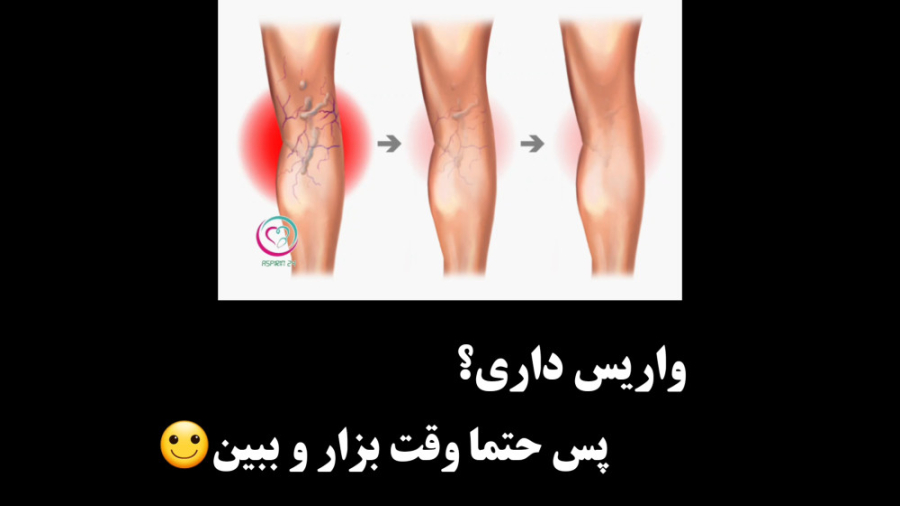 درمان واریس جواد رضویان