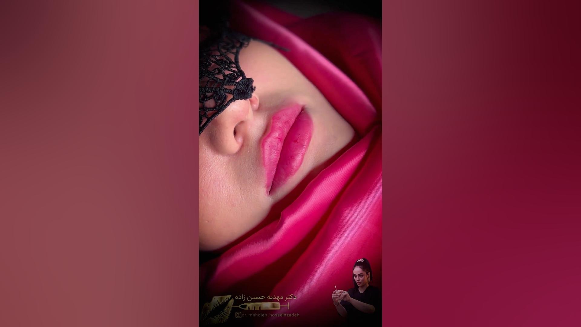 تزریق ژل لب روسی در رشت دکتر مهدیه حسین زاده کلینیک زیبایی رشت دکتر مهدیه حسین زاده