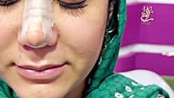 تزریق فیلر لب