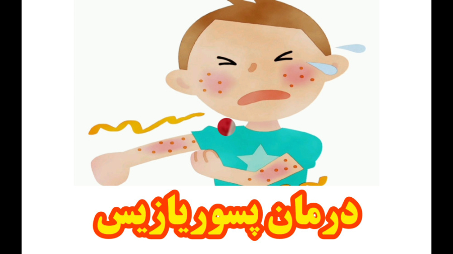 درمان پسوریازیس میکرونیدلینگ
