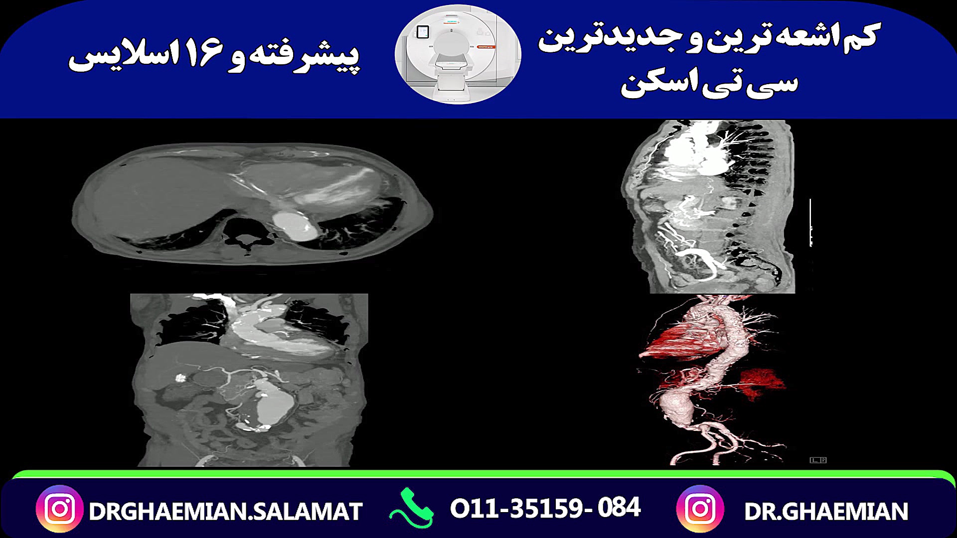 سی تی آنژیوگرافی آنوریسم آئورت شکمی از زوایای مختلف و سه بعدی ترمیم دندان
