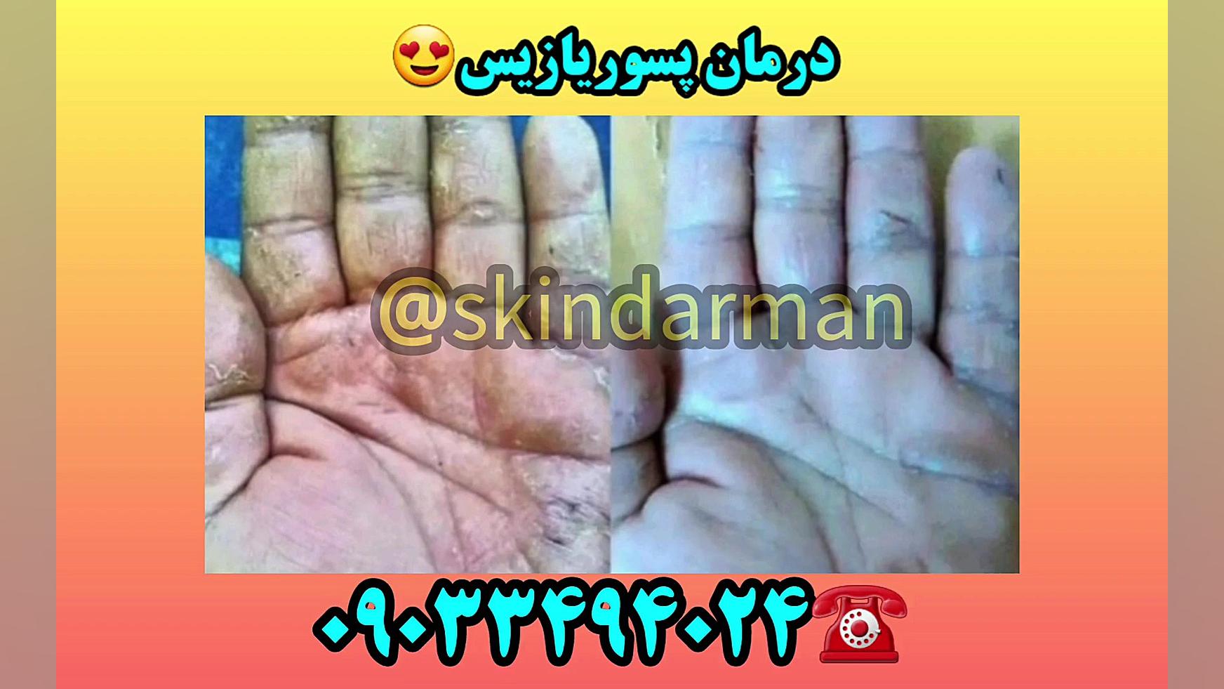 درمان پسوریازیس دندانپزشک زیبایی