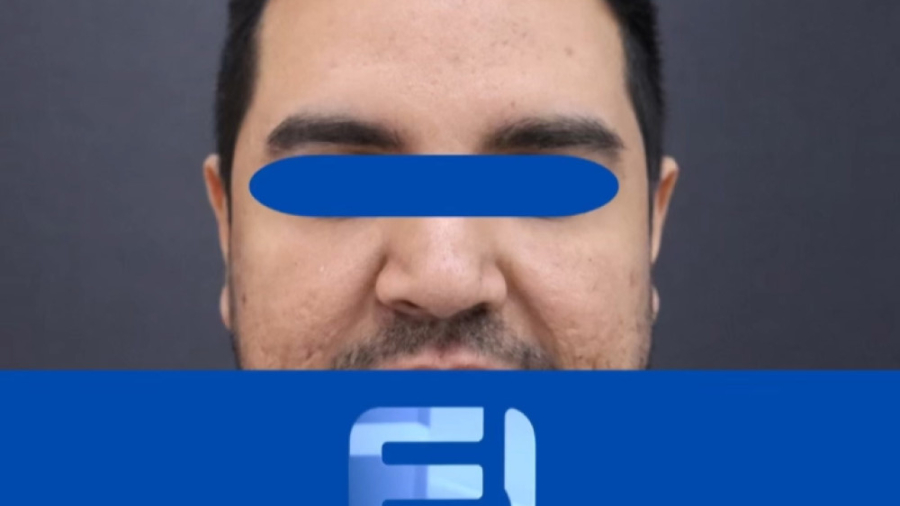 نمونه کار تزریق بوتاکس دیستون - قبل و بعد استریمر نق‌نقو