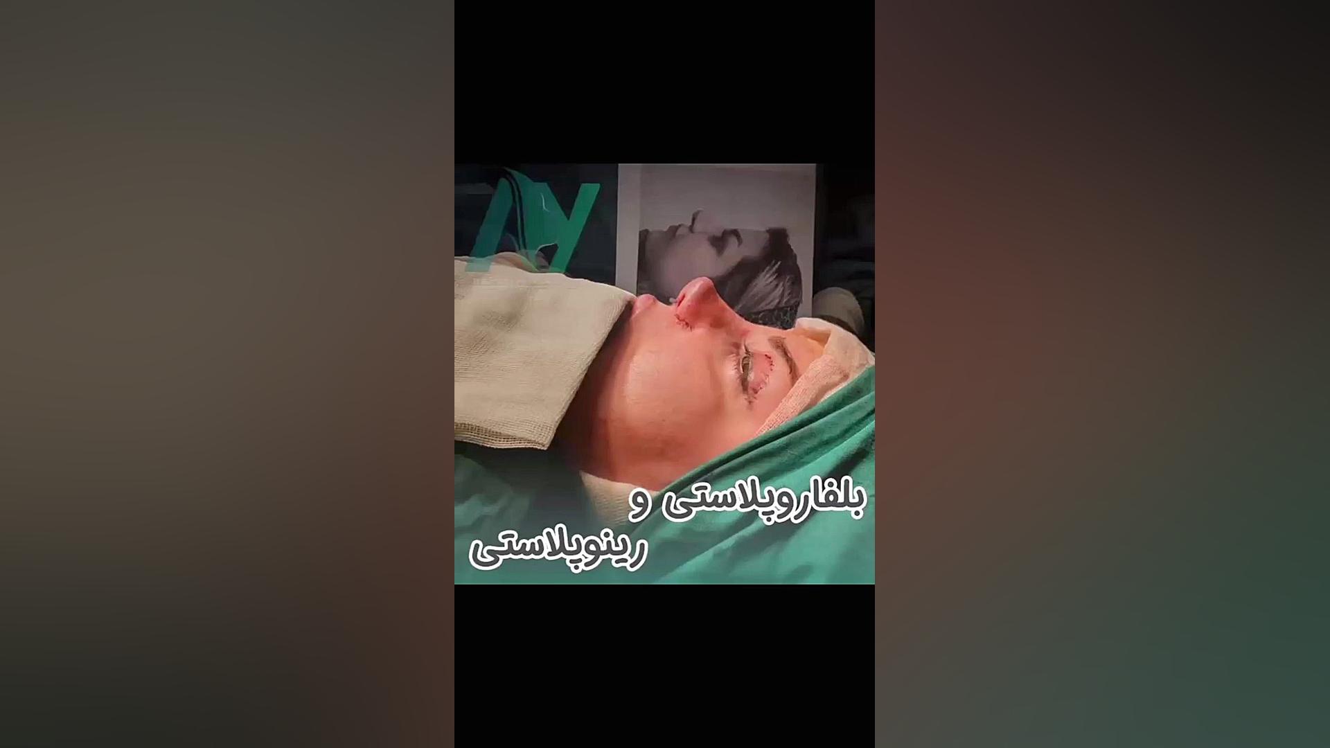 رینوپلاستی همزمان با بلفاروپلاستی دکتر محمودرضا اصحاب یمین - فوق تخصص پلاستیک