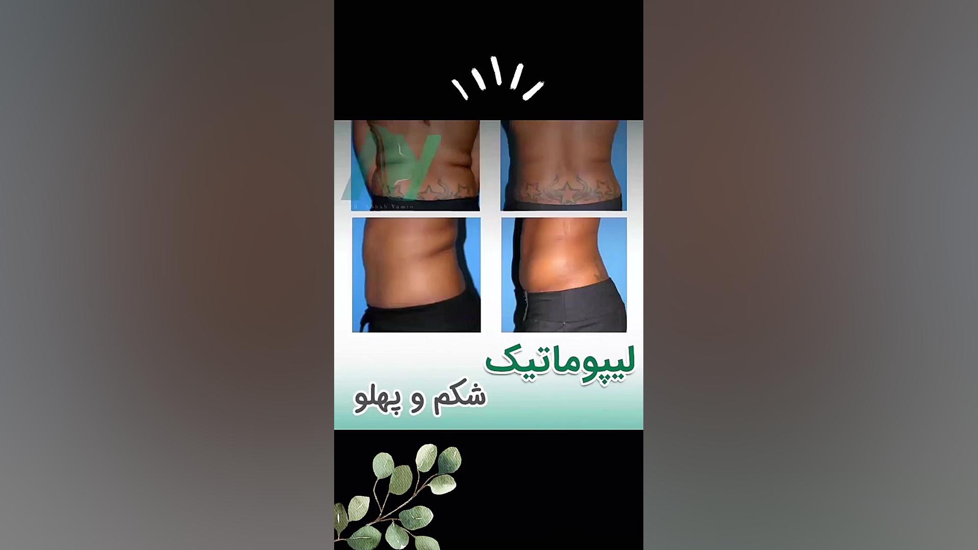 لیپوماتیک شکم و پهلو دکتر محمودرضا اصحاب یمین - فوق تخصص پلاستیک