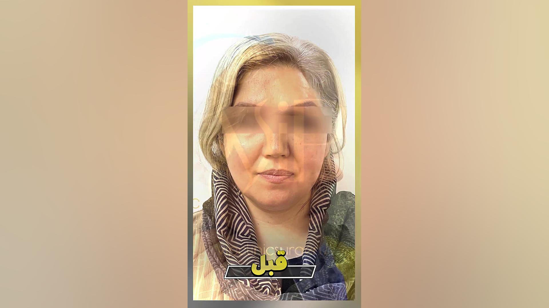 لیپوساکشن غبغب - کلینیک vip تهران زوترلینیب