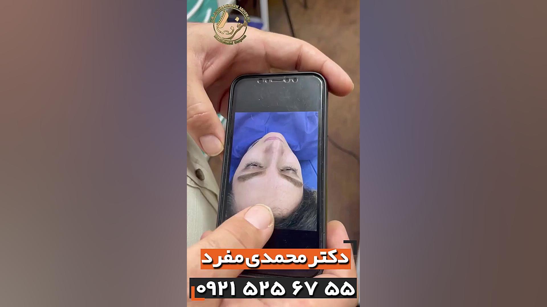 عمل زیبایی بینی ، دکتر امیرحسین محمدی مفرد 09215256755 دکتر امیر حسین محمدی مفرد