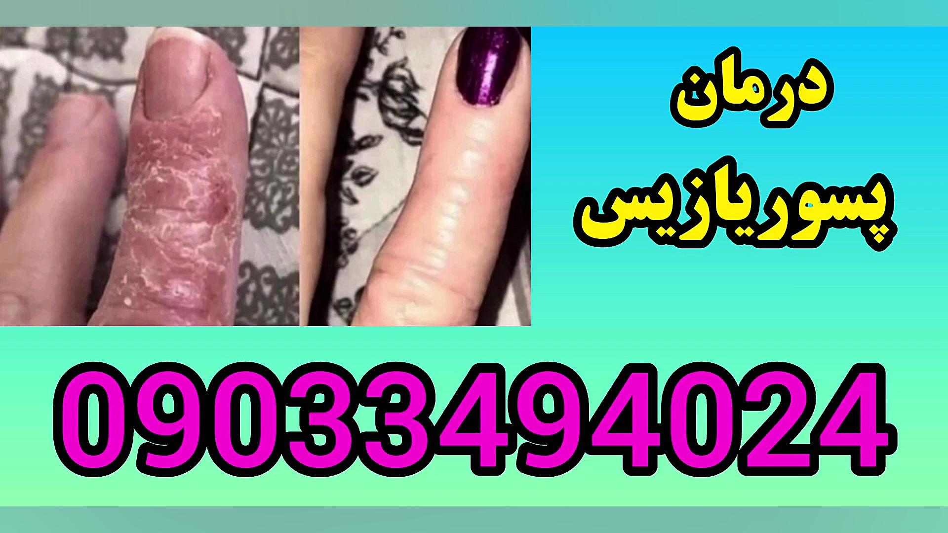 درمان پسوریازیس مهناز افشار