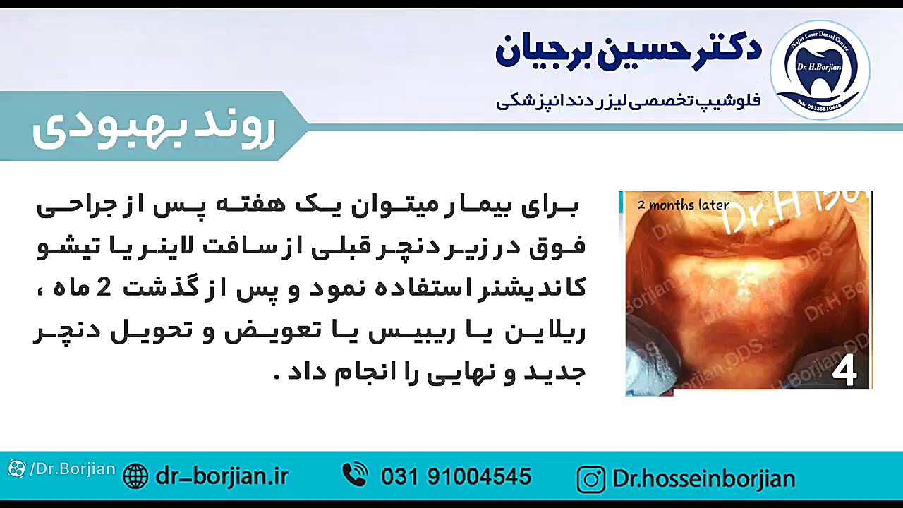 نمونه جراحی پیش پروتزی (3) | بهترین دندانپزشک زیبایی اصفهان هیدروپس فتالیس