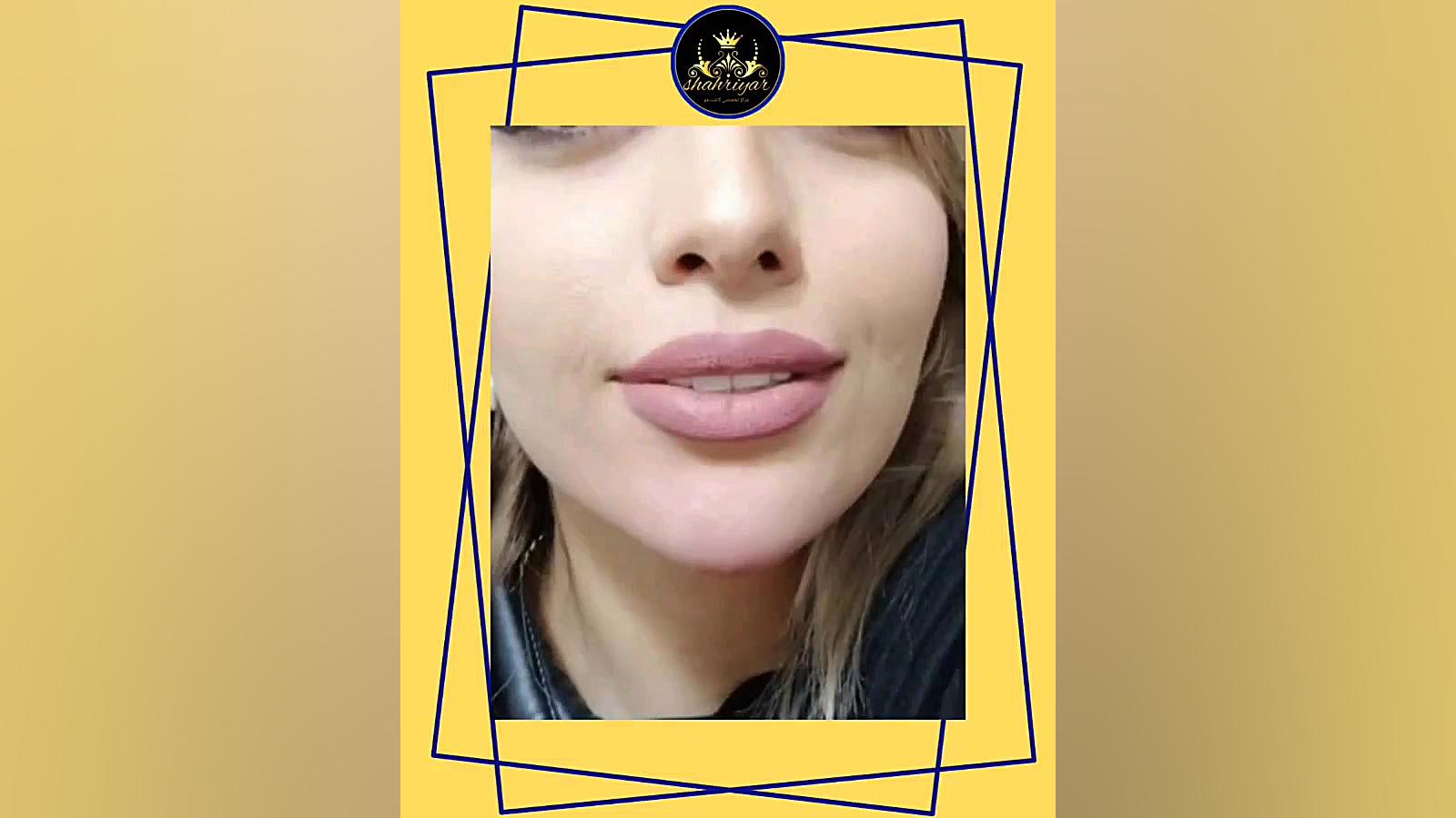 زاویه سازی صورت هپوپلازی مغز استخوان