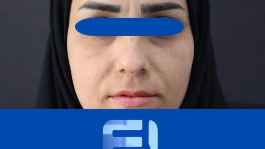 نمونه کار تزریق بوتاکس مصپورت - قبل و بعد پیلینگ شیمیایی