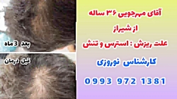 ریزش مو در بارداری
