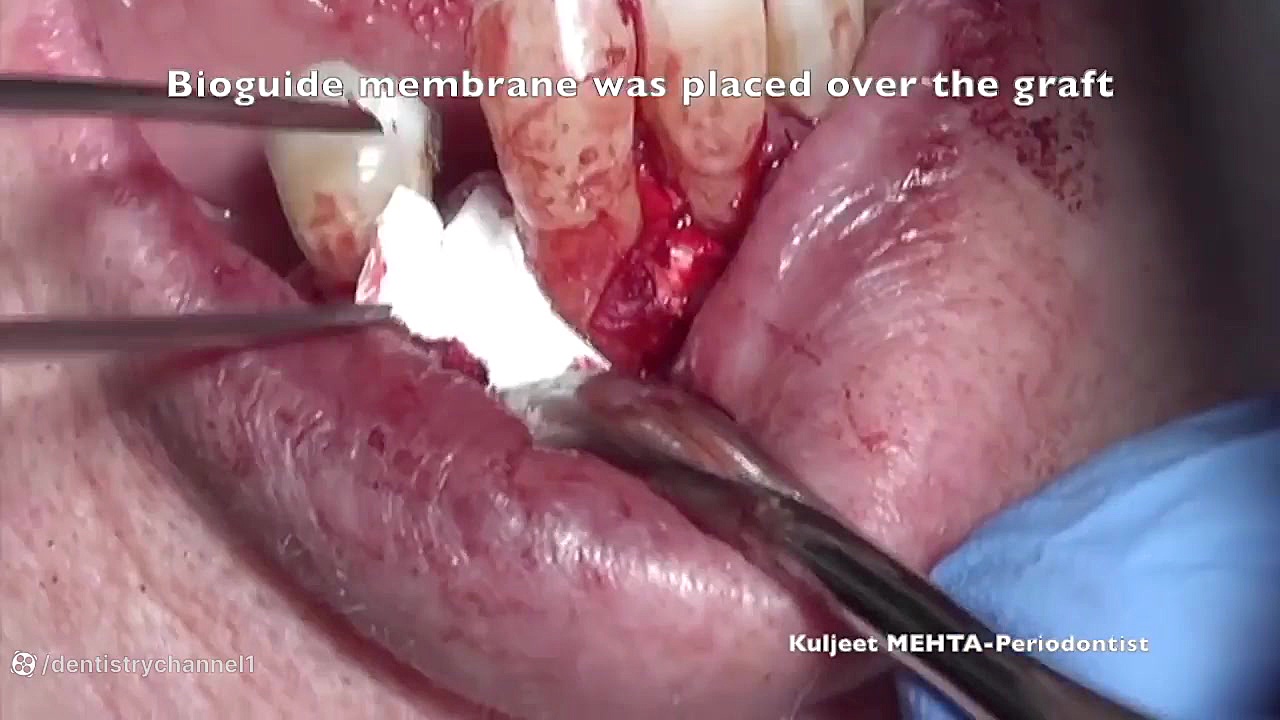 جراحی پریودنتال با GTR GRO-Seq