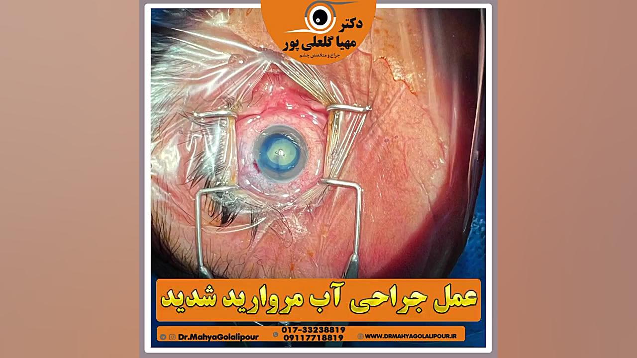 عمل جراحی آب مروارید (کاتاراکت) شدید روکش دندان