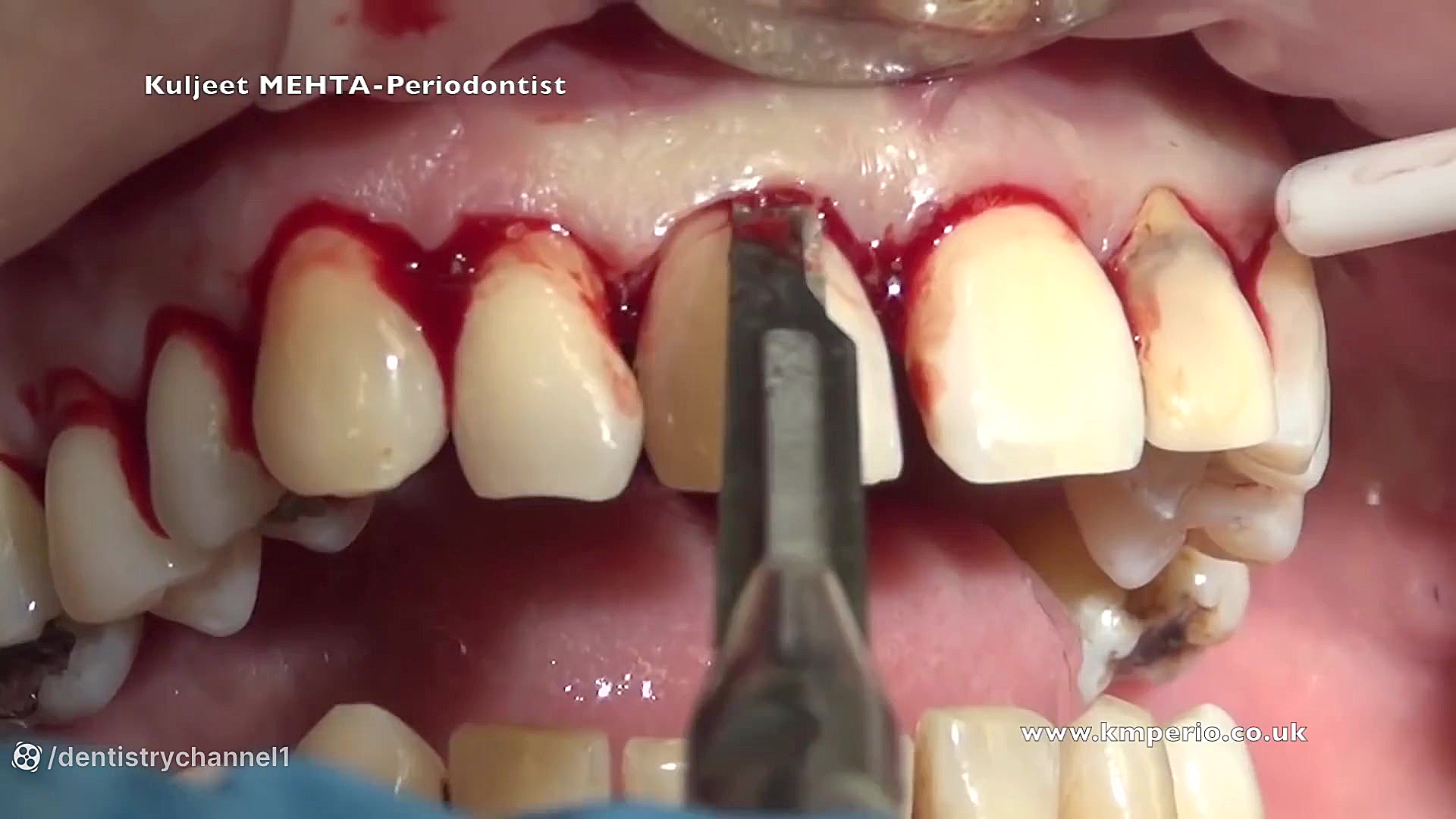 جراحی پریودنتال دندان های قدامی بالا لیفت ابرو