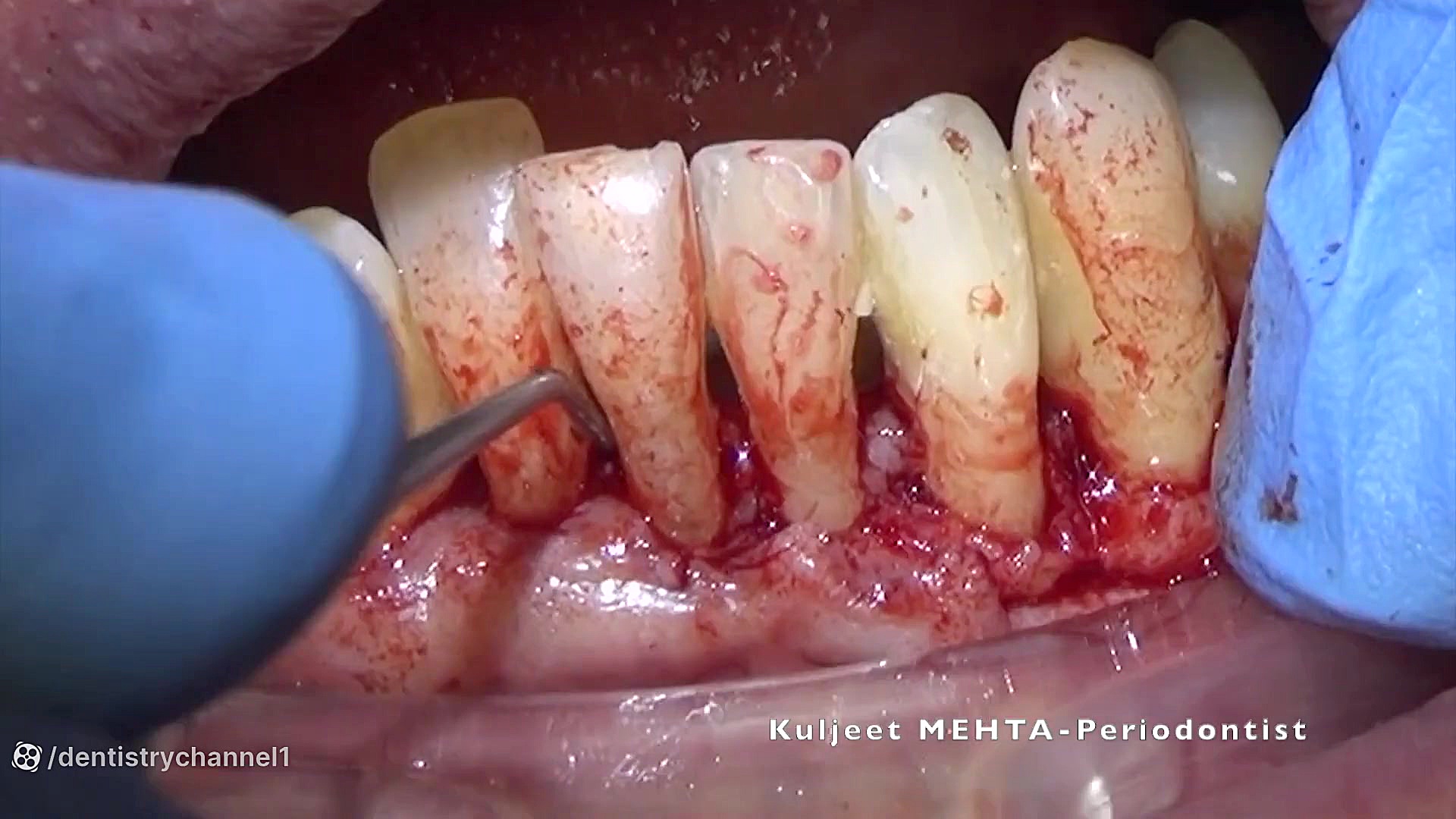 جراحی پریودنتال دندان های قدامی پایین دندان مصنوعی