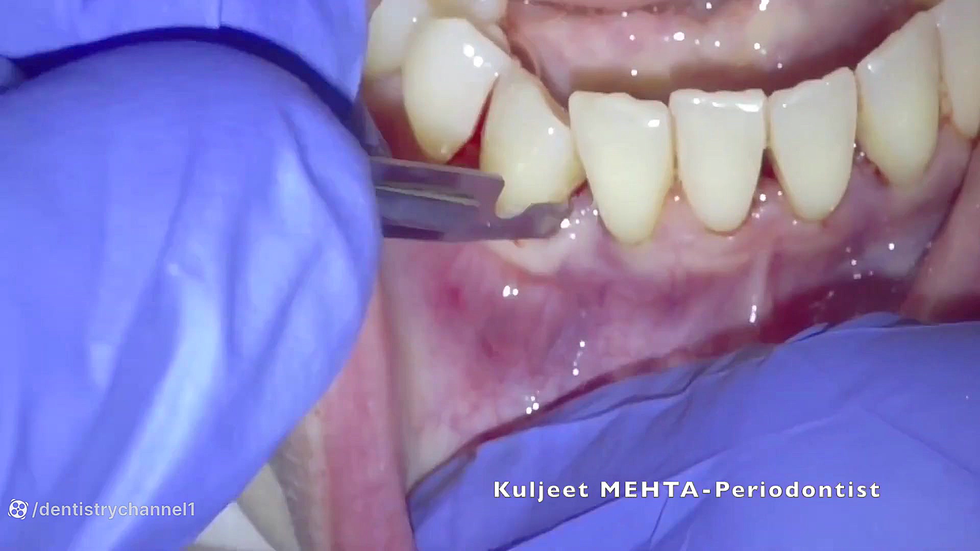 جراحی پریودنتال با PRF بیماری گلوکوزامینوگلیکان تجمعی