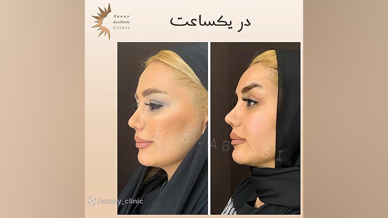 ليفت ابرو( چشم گربه اى) پزشکی تله‌مدیسین تخصصی