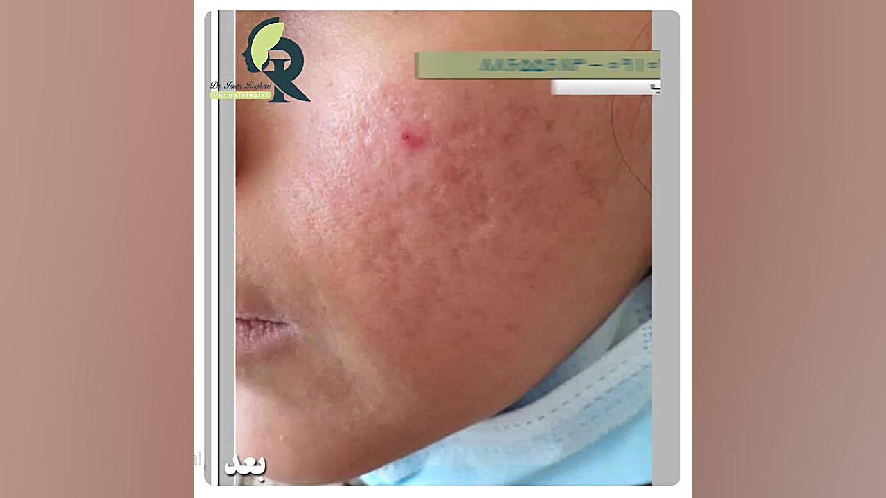 موثرترین درمان برای صاف کردن پوست صورت دکتر ایمان روغنی جراح و متخصص پوست و مو