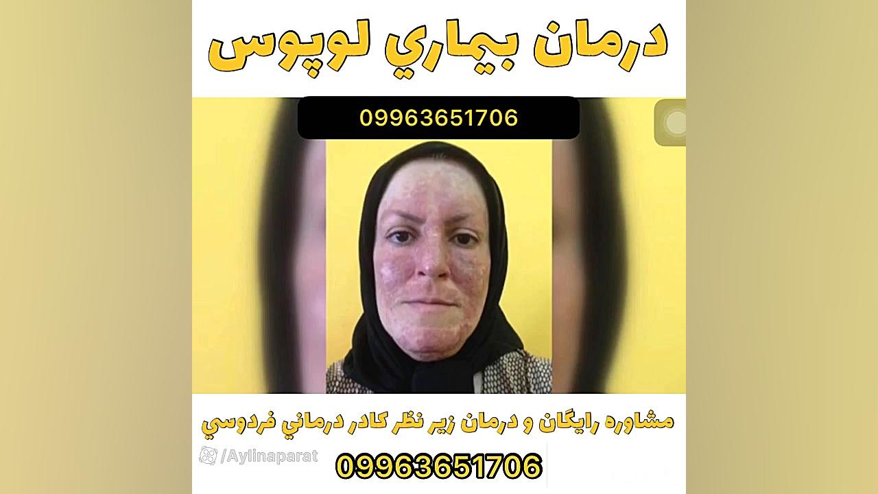 درمان لوپوس در زنان لیزر مو