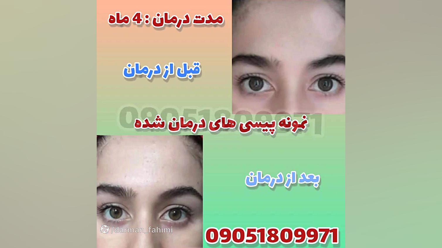 لکه های پوستی بهبود یافت اصلاح فرم صورت