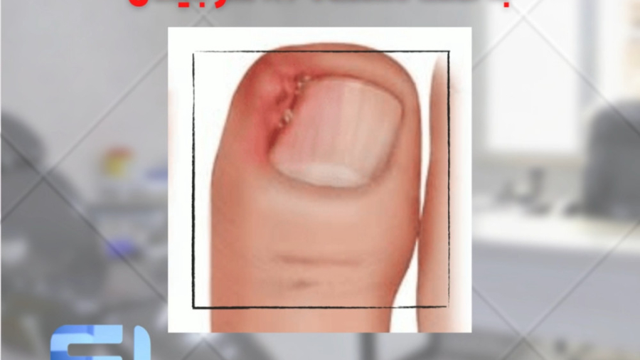 جراحی ناخن فرو رفته در گوشت پا