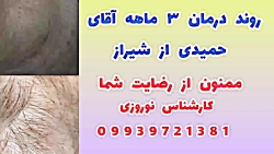 درمان قطعی ریزش مو