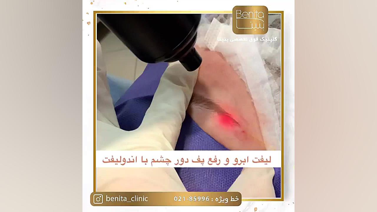 لیفت ابرو و رفع پف دور چشم با اندولیفت کاتاپلکسی