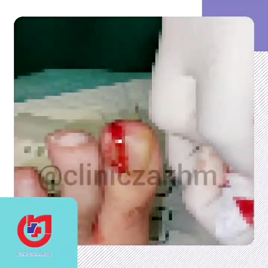 درمان قطعی عفونت ناخن  در کلینیک زخم نور۰۹۰۲۷۰۰۹۸۷۶