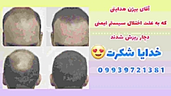 ریزش مو در زنان