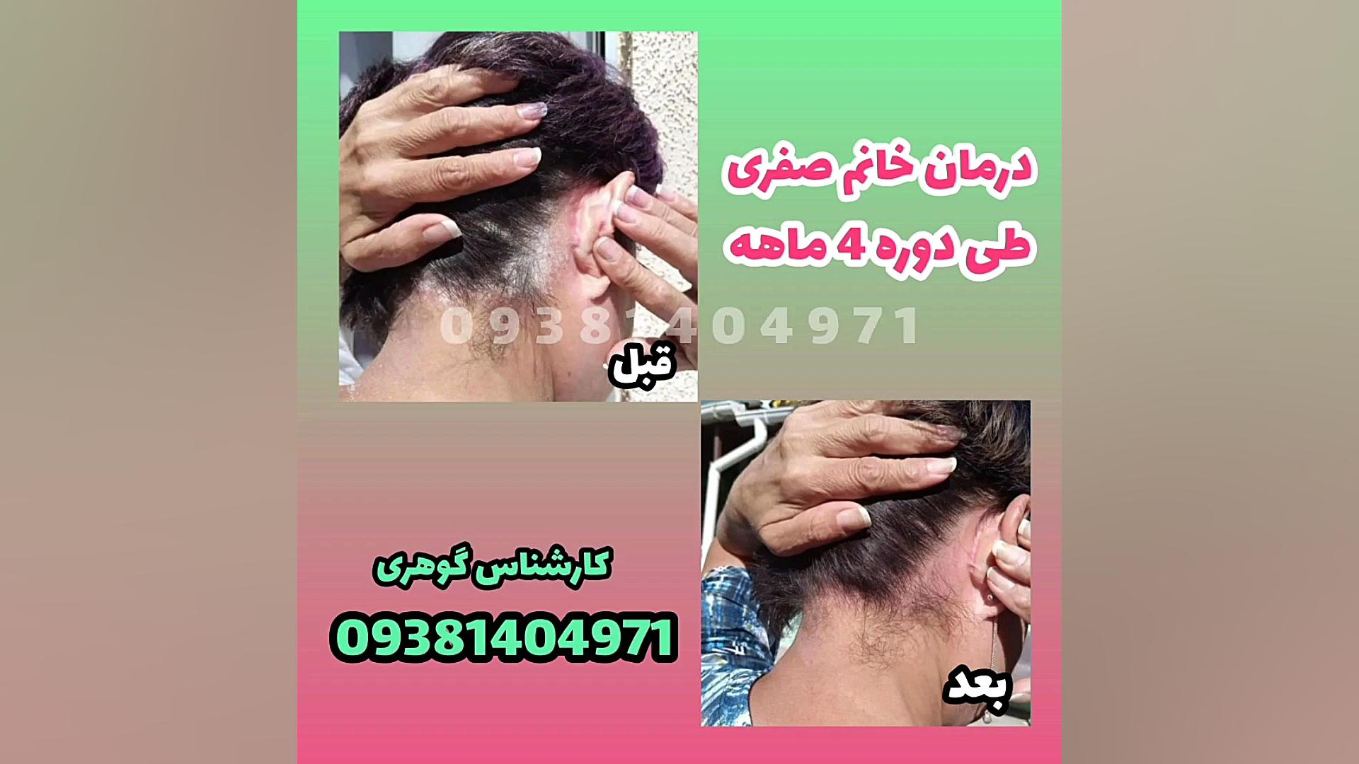 درمان لوپوس پروتز دندان