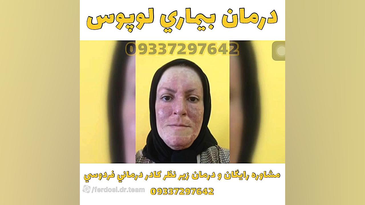 درمان بيماري لوپوس در زنان لیپوساکشن