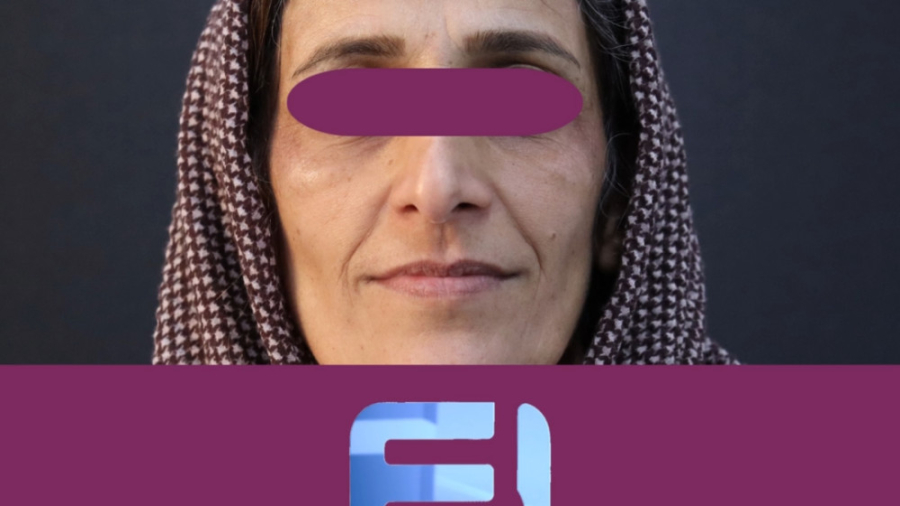 تزریق فیلر رووفیل Ultra برای خط خنده