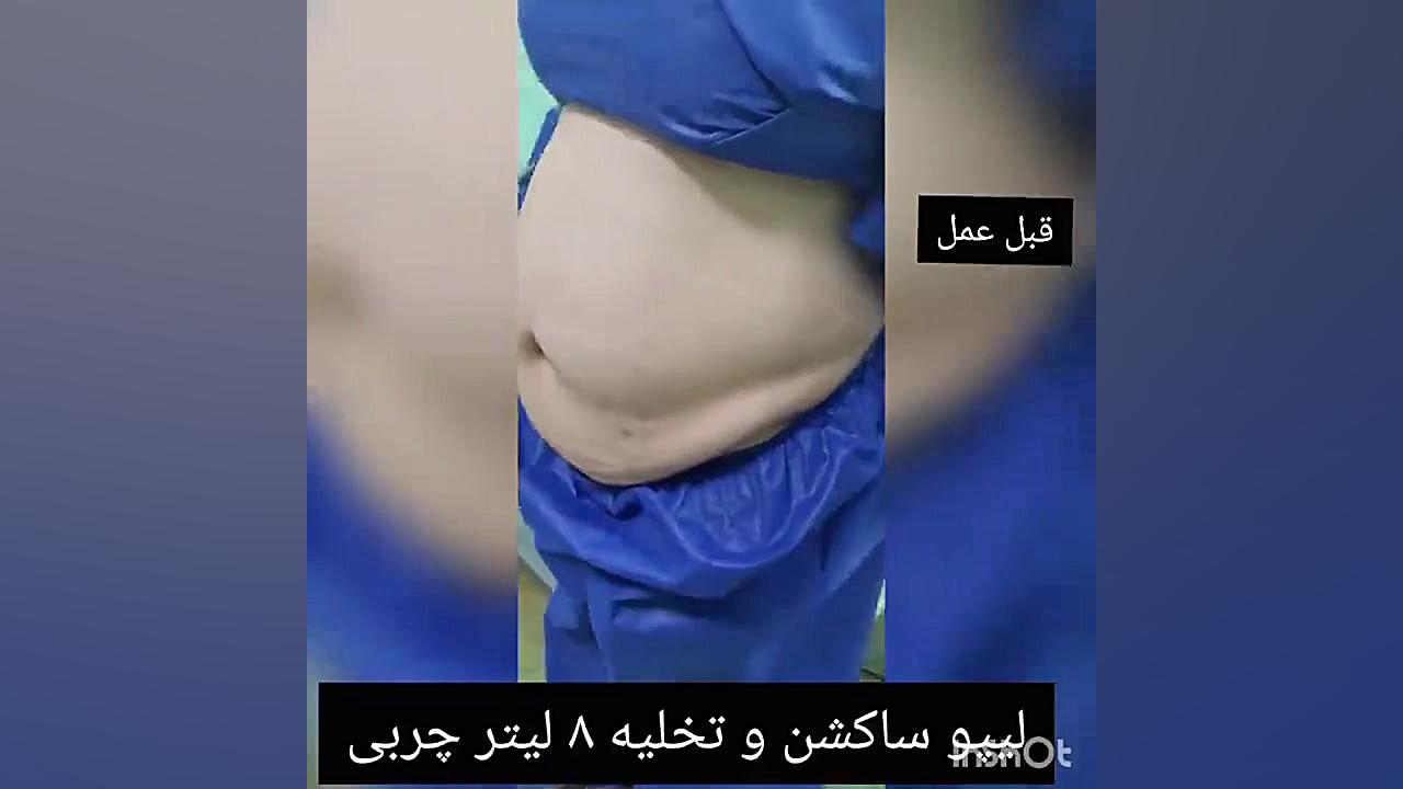 لیپو ساکشن - دکتر سامان اکبری Autophagy Detection Kit