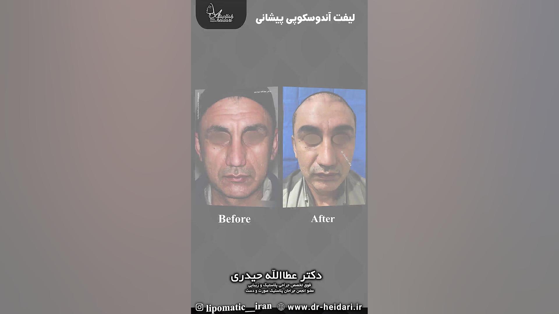 لیفت آندوسکوپی پیشانی لیفت صورت