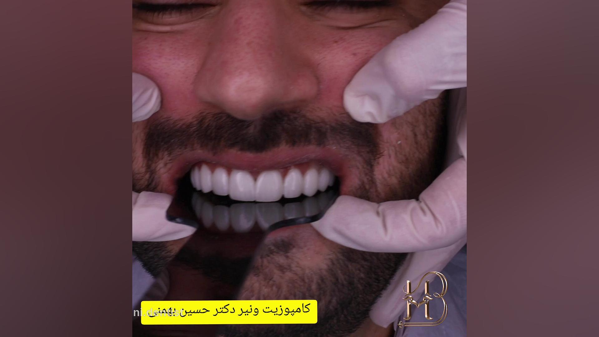 کامپوزیت ونیر نانوسرامیک با تکنیک دکتر حسین بهمنی درمان سلول‌های بنیادی