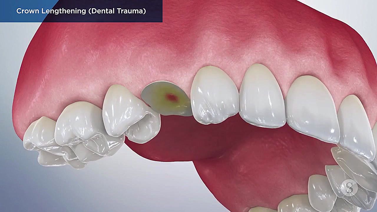 جراحی لثه دکتر سمانه شهابی || جراح، دندانپزشک و متخصص اندو