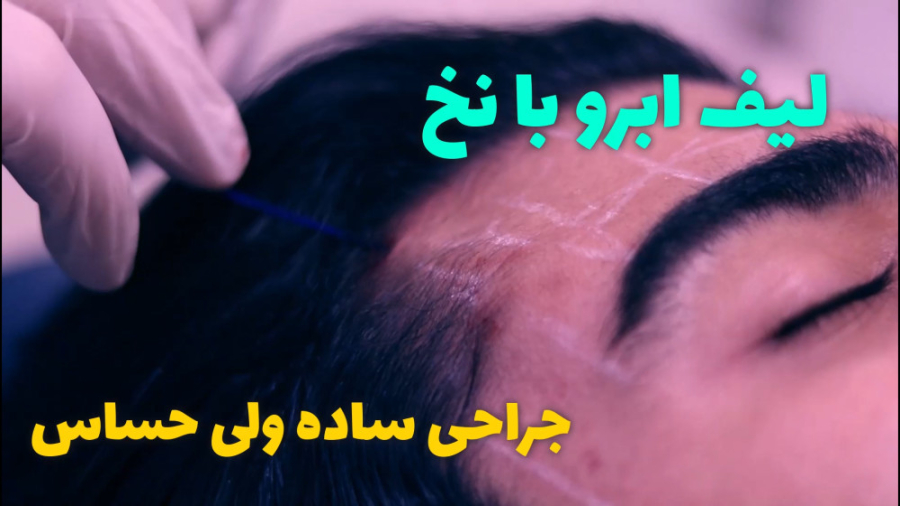 لیفت ابرو با نخ ( لیفت شقیقه ) سیستم نانواینژکتور
