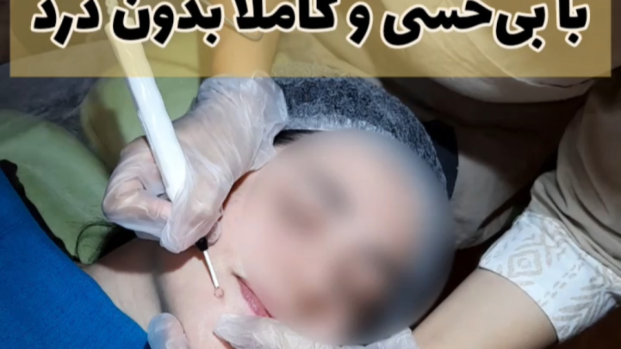 برداشتن خال با بی حسی و کاملا بدون درد برداشتن زگیل