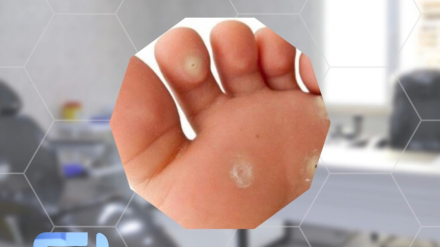 جراحی میخچه توسط دکتر فرخ جافری