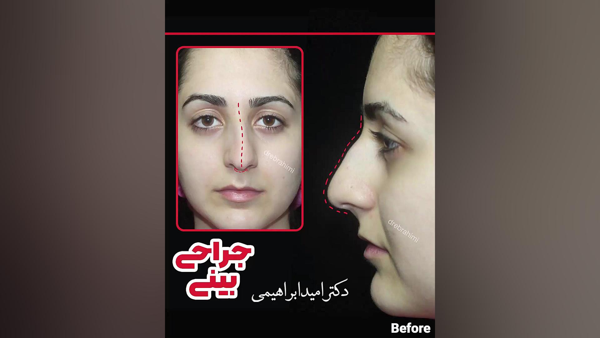 جراحی انحراف بینی استخوانی توسط دکتر امید ابراهیمی بهترین جراح بینی در تهران دکتر امید ابراهیمی